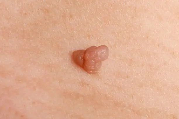 cancer papilloma on the skin, wart close up.