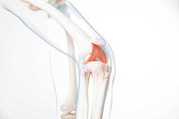 istock Human leg,  knee meniscus, medically accurate representation of an arthritic knee joint 1407500626