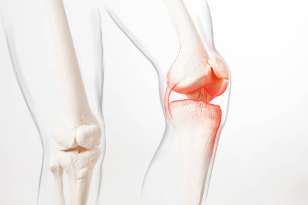 istock Human leg,  knee meniscus, medically accurate representation of an arthritic knee joint 1407500645