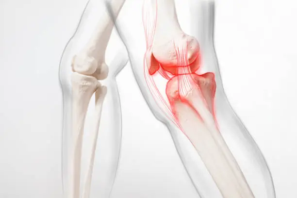 Photo of Human leg,  knee meniscus, medically accurate representation of an arthritic knee joint