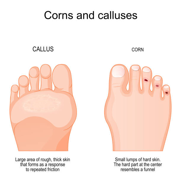 odciski na palcach i modzele na podeszwie. - calluses stock illustrations