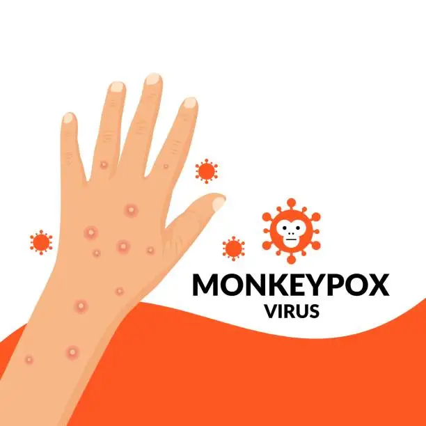 Vector illustration of Vector illustration, hands exposed to monkeypox virus, as an educational poster or banner.