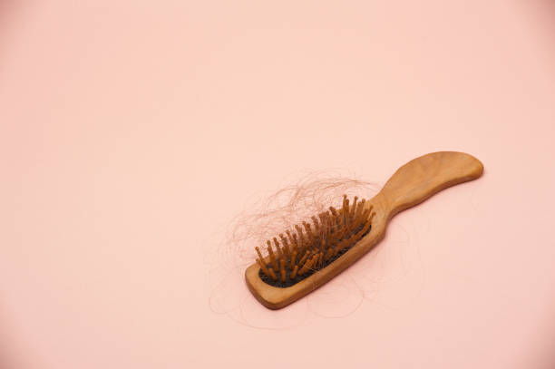 istock hair loss 1407869022