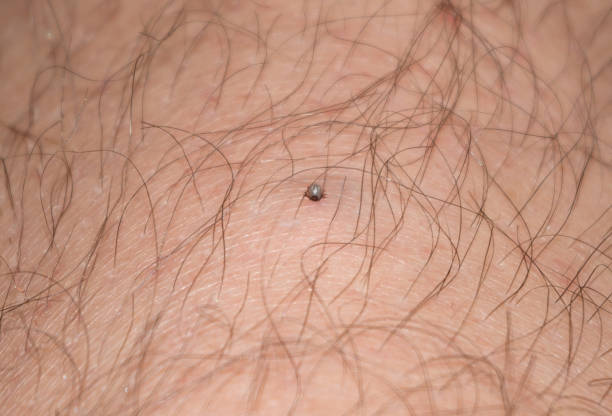 The tick feeds. A tick on a man's leg. The tick feeds. erythema nodosum stock pictures, royalty-free photos & images