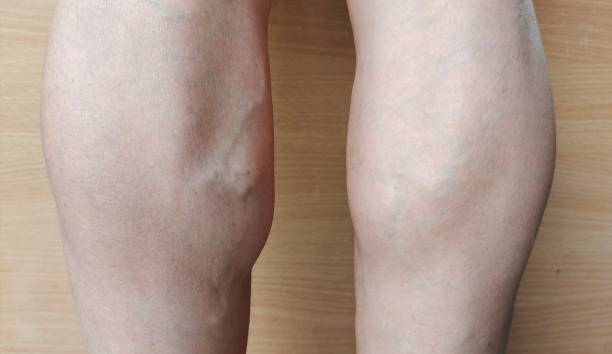istock Calf muscle and varicose veins. 1407931377