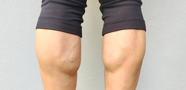 istock Calf muscle and varicose veins. 1407931478