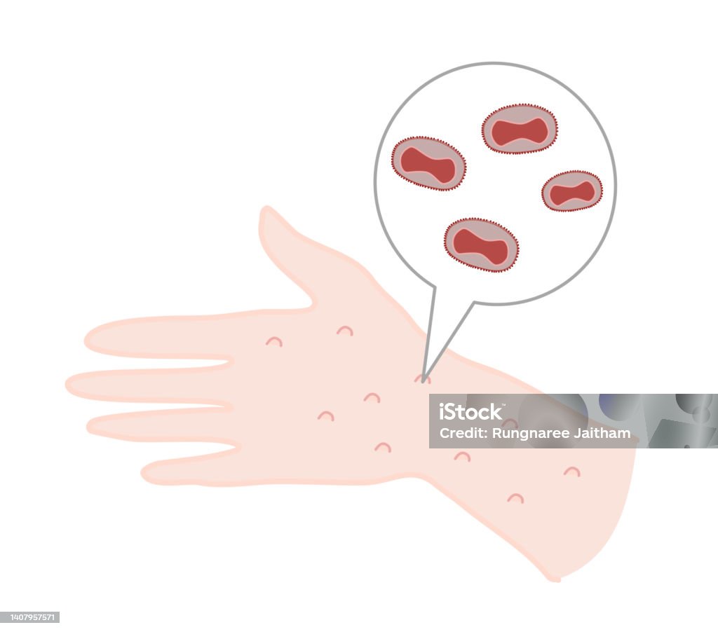 Smallpox Hand Image The Rash On Human Hand Are Pathology Symptom Of Smallpox Or Monkeypox ...
