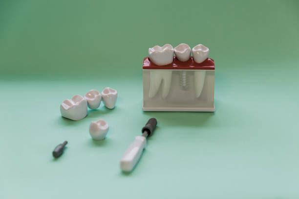 istock Dental Tooth Bridge Model tiffany blue color 1408040891