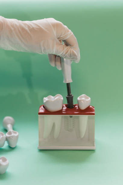 istock Dentist In Gloves Showing Dental Tooth Bridge Model 1408040910
