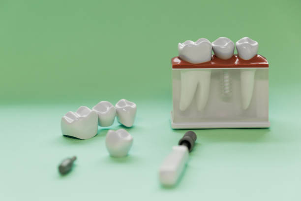 istock Dental Tooth Bridge Model tiffany blue color 1408040915