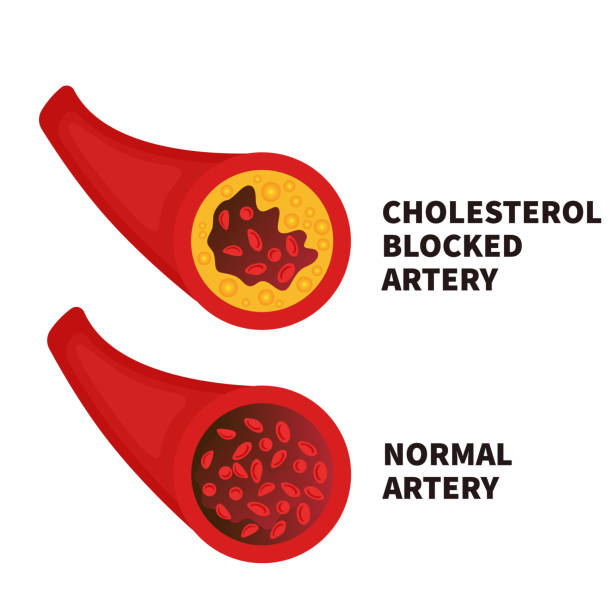 ilustraciones, imágenes clip art, dibujos animados e iconos de stock de ilustración de la sección transversal de la arteria normal y estrechada - lipoprotein