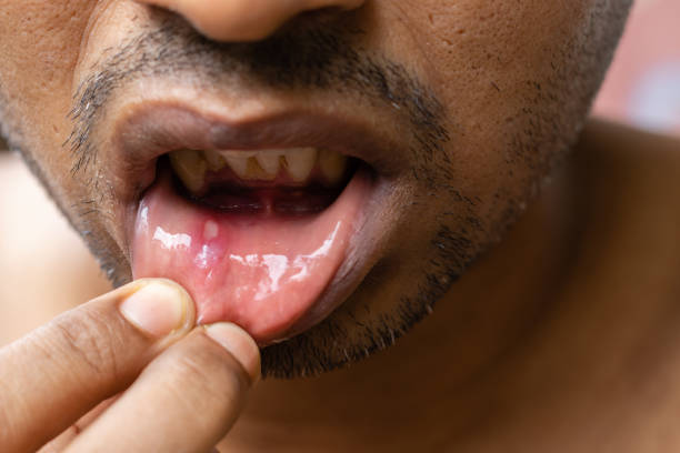 istock Painful mouth ulcer 1408057623