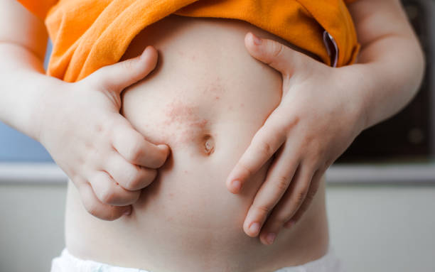 bambino di varicella. il virus della varicella zoster o scabbia eruzione cutanea sul bambino. - cute little boys caucasian child foto e immagini stock