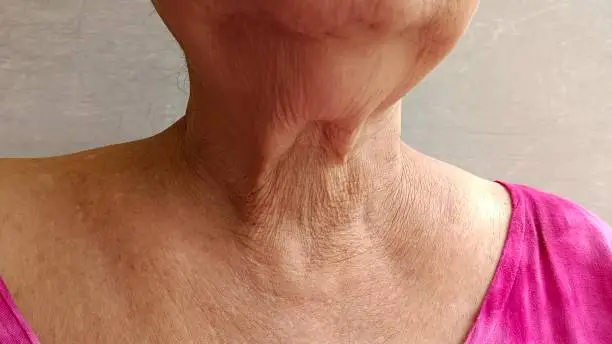 The skin of the neck of the elderly is wrinkled