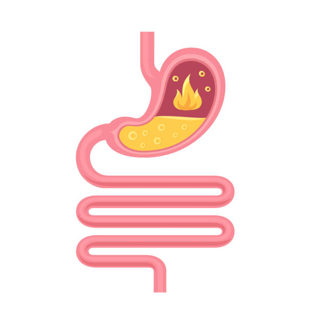istock Acid reflux, pyrosis or heartburn concept. Human stomach anatomy. Gastrointestinal tract and digestive system. 1408163552