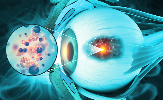 Eye cancer, eye disease, human eyeball with cancerous cells spreading, 3d illustration