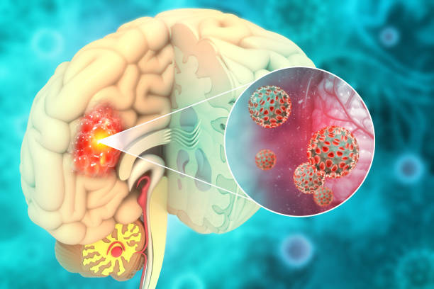 Brain cancer, showing presence of tumor inside brain. 3d illustration stock photo
