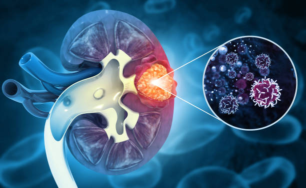 istock Diseased human kidney. kidney cancer. 3d illustration 1408177199