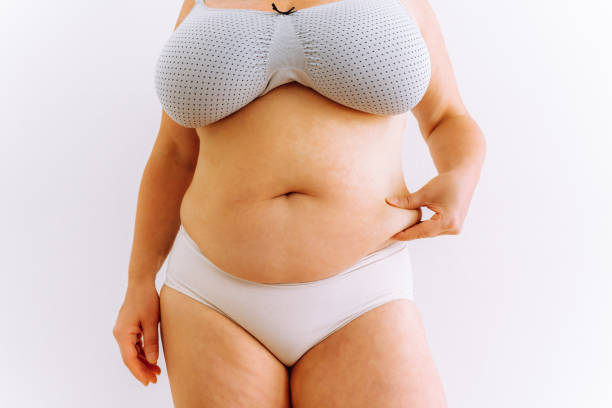 istock sagging skin with age spots on fat belly, plastic surgery concept 1408204698