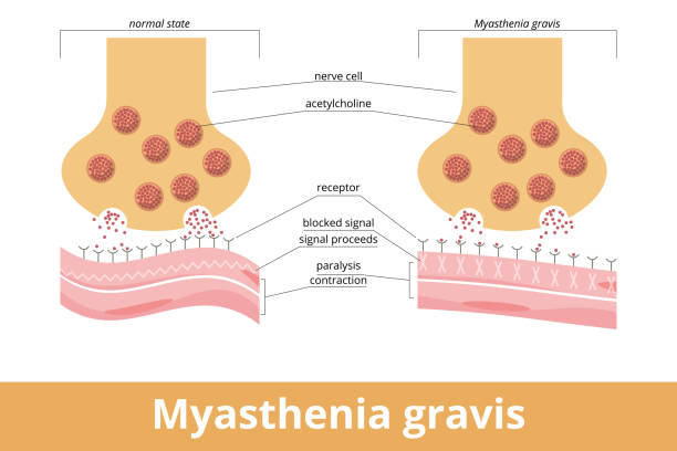 ilustraciones, imágenes clip art, dibujos animados e iconos de stock de miastenia gravis - acetylcholine