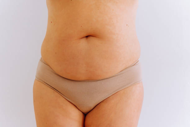 istock sagging skin with age spots on fat belly, plastic surgery concept 1408207735