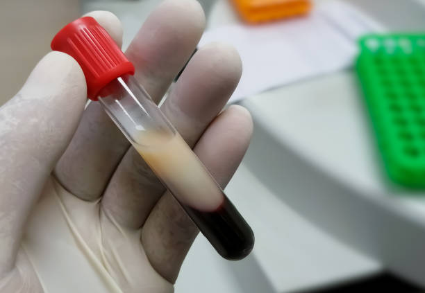 científico o bioquímico sostienen tubo de ensayo con muestra de sangre lipémica. los triglicéridos altos contienen muestras de sangre. perfil lipídico - stike fotografías e imágenes de stock