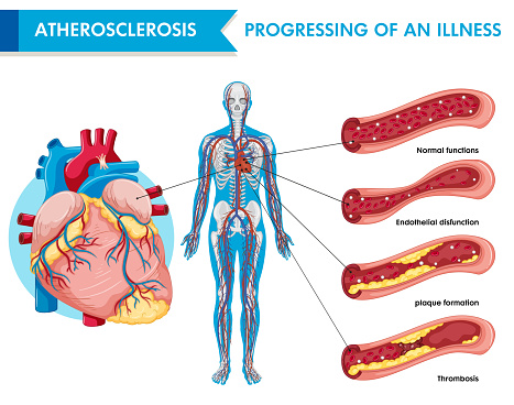 Atherosclerosis progression of an illness illustration
