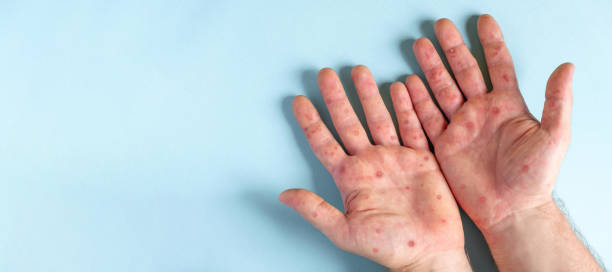 Male hands with Monkeypox rash. Patient with MonkeyPox viral disease. Close Up of Painful rash, red spots blisters on the skin. Human palm with Health problem. Banner, copy space. Allergy, dermatitis. Male hands with Monkeypox rash. Patient with MonkeyPox viral disease. Close Up of Painful rash, red spots blisters on the skin. Human palm with Health problem. Banner, copy space. Allergy, dermatitis. Ill eczema skin of patient. Viral Diseases. Red rashes on the palm. Enterovirus. coxsackie hand foot and mouth disease stock pictures, royalty-free photos & images