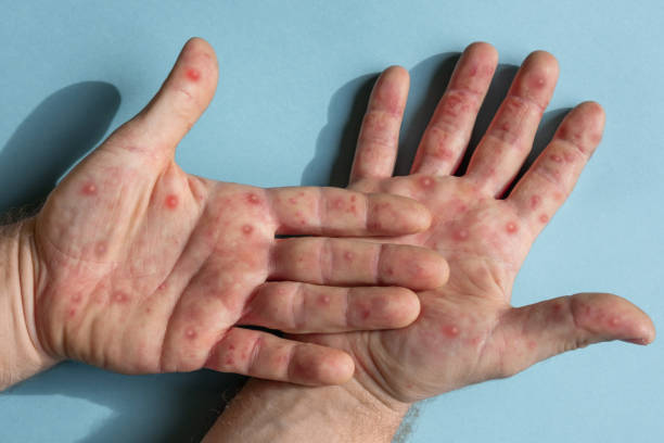 männliche hände mit affenpockenausschlag. patient mit monkeypox-viruserkrankung. nahaufnahme von schmerzhaftem hautausschlag, rote flecken blasen auf der haut. menschliche handfläche mit gesundheitsproblem. banner, leerzeichen kopieren. allergie, dermat - zoster stock-fotos und bilder