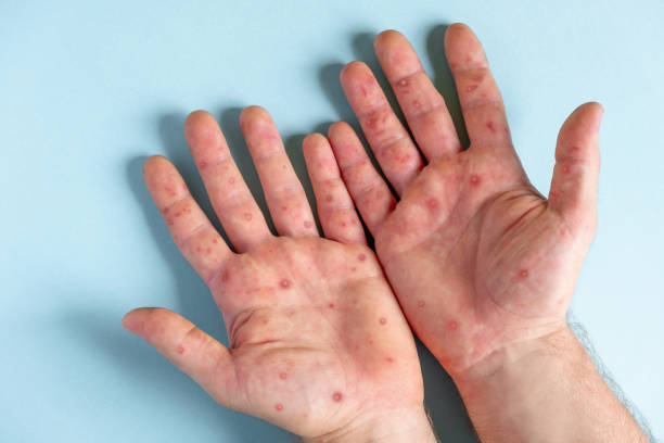 Male hands with Monkeypox rash. Patient with MonkeyPox viral disease. Close Up of Painful rash, red spots blisters on the skin. Human palm with Health problem. Banner, copy space. Allergy, dermatitis. Male hands with Monkeypox rash. Patient with MonkeyPox viral disease. Close Up of Painful rash, red spots blisters on the skin. Human palm with Health problem. Banner, copy space. Allergy, dermatitis. Ill eczema skin of patient. Viral Diseases. Red rashes on the palm. Enterovirus. coxsackie hand foot and mouth disease stock pictures, royalty-free photos & images