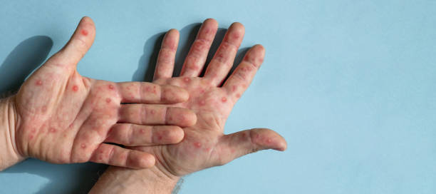 Male hands with Monkeypox rash. Patient with MonkeyPox viral disease. Close Up of Painful rash, red spots blisters on the skin. Human palm with Health problem. Banner, copy space. Allergy, dermatitis. Male hands with Monkeypox rash. Patient with MonkeyPox viral disease. Close Up of Painful rash, red spots blisters on the skin. Human palm with Health problem. Banner, copy space. Allergy, dermatitis. Ill eczema skin of patient. Viral Diseases. Red rashes on the palm. Enterovirus. coxsackie mpox stock pictures, royalty-free photos & images