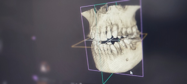 three-dimensional radiography, 3d, dental ct