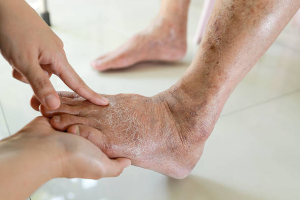 Hands of doctor or nurse examining the dry,cracked,swollen feet of old elderly people,skin care problems,senior woman with diabetes or kidney disease causing swollen legs,health care,medical concept manos de médico o enfermera que examinan los pies secos, agrietados, hinchados de personas mayores, problemas de cuidado de la piel, mujer mayor con diabetes o enfermedad renal que causa piernas hinchadas, atención médica, concepto médico