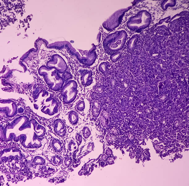 istock Microscopic image of Gastric carcinoid tumor, rare tumors that develop within the gastric mucosa. Neuroendocrine tumor (NET). 1408665828