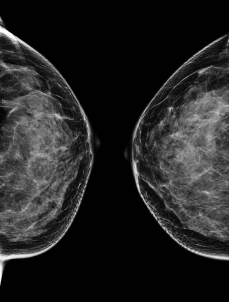 mammografia digitale a raggi x o mammografia della vista cc del seno. - lactiferous duct foto e immagini stock