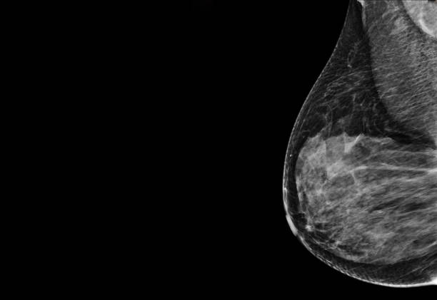 X-ray Digital Mammogram  or mammography  of the breast  mlo view. X-ray Digital Mammogram  or mammography  of the breast  MLO view  for diagnonsis Breast cancer in women isolated on black background. mg42 stock pictures, royalty-free photos & images