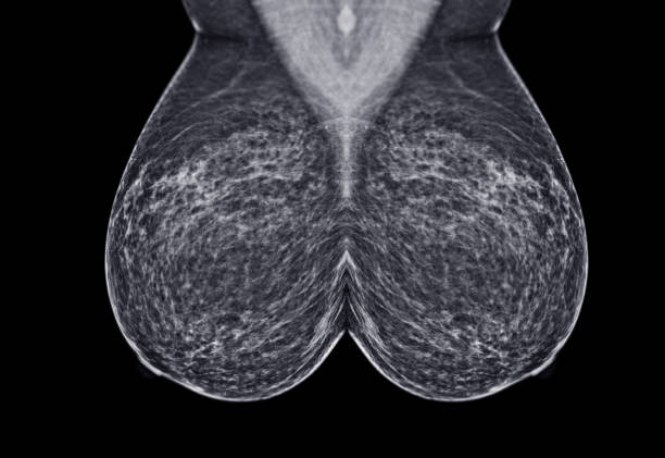 mammographie numérique à rayons x ou mammographie de la vue mlo du sein. - lactiferous duct photos et images de collection