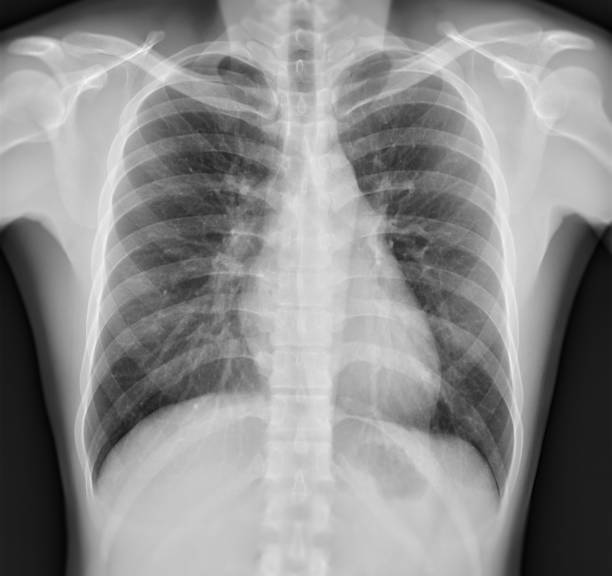 Chest x-ray image. stock photo
