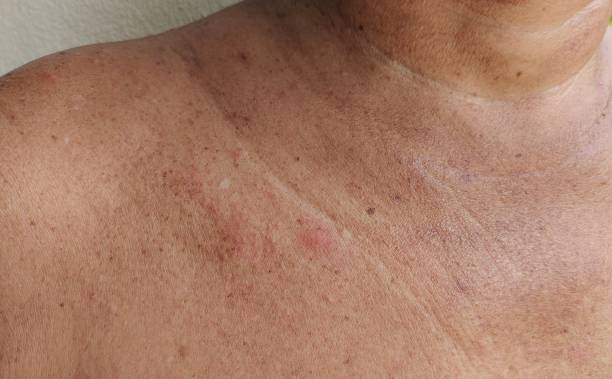 The acne and blemishes on the torso, dermatitis and dark spots on the body. Portrait showing the acne and dark spots, dullness and rough skin on the body, neck wattle under the neck, problem wrinkles and flabby of the man, concept health care. irritation photos stock pictures, royalty-free photos & images
