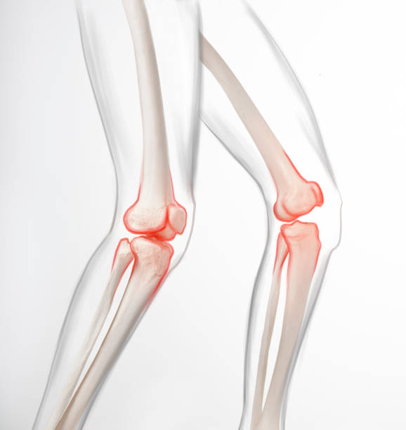 istock Human legs,  knee meniscus, medically accurate representation of an arthritic knee joint 1409075759