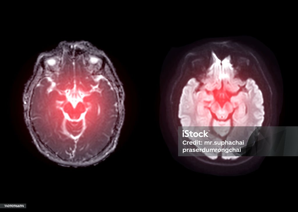 MRI  brain  axial diffusion image  for detect stroke disease and Brain tumors and cysts. Chronic Traumatic Encephalopathy Stock Photo