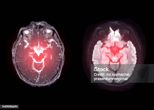 Mri Brain Axial Diffusion Image For Detect Stroke Disease And Brain Tumors And Cysts Stock Photo - Download Image Now