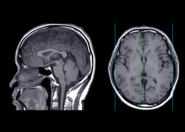 istock MRI  brain  axial T1W  plane  sagittal and axial view . 1409096720