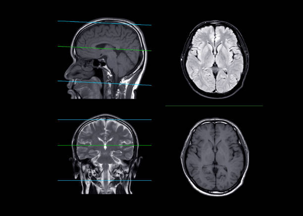 istock MRI  brain compare axial, coronal and sagittal plane 1409096805