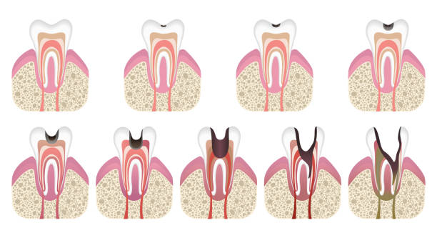 illustrations, cliparts, dessins animés et icônes de stades de développement de la carie. structure dentaire de style plat. carie dentaire avec de l’émail. caries de maladies dentaires, pulpite et parodontite, illustration vectorielle réaliste - dentist office dentists chair dentist dental hygiene