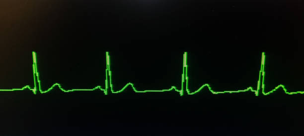 istock ECG Sinus Rhythm (Normal EKG) on Telemetry Monitor 1409234365