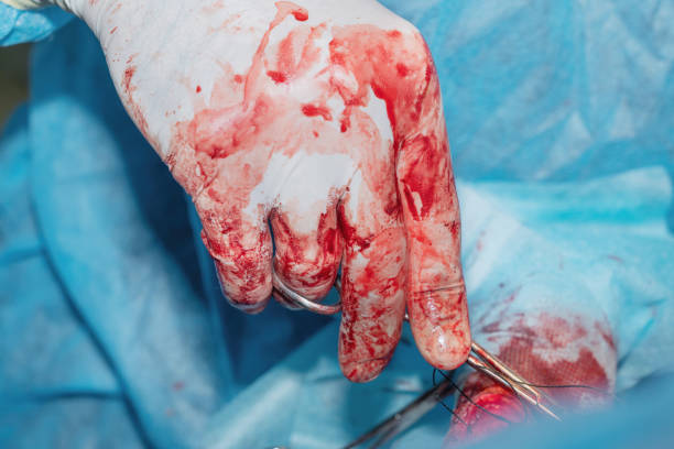 istock Hand of a surgeon during surgery 1409266517