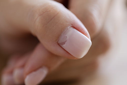 Primer plano de uñas rotas agrietadas. Daño por debilidad de las uñas por el recubrimiento de esmalte de gel. photo