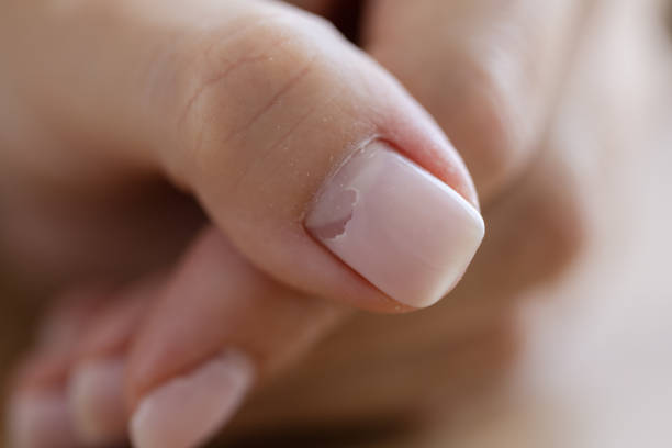 istock Cracked broken nail closeup. Nail weakness damage from gel polish coating. 1409337328