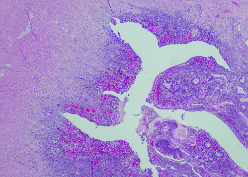 Ulcerative colitis with pseudopolyposis, Site: Colon